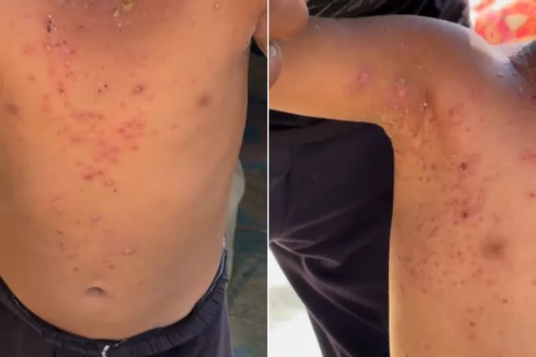 لأمراض الجلدية تنهش أجساد أطفال غزة