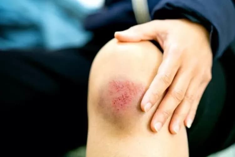 بروتين من ديدان طفيلية يعزز التئام الجروح ويقلل التندب