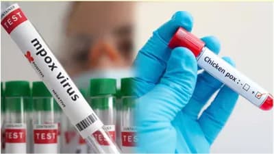 الأردن يسجل حالة إصابة بجدري القرود