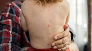 نقابة تحذر من انتشار "بوحمرون"